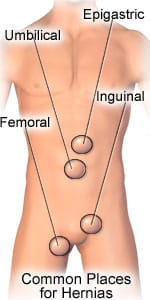 Illustration of common places hernias occur