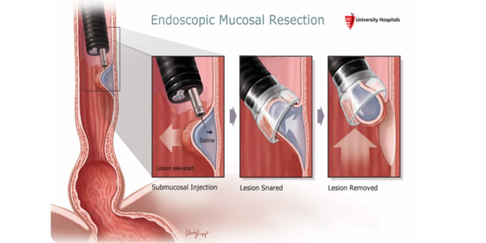 Illustration of the three basic steps taken in Endoscopic Mucosal Resection (EMR)