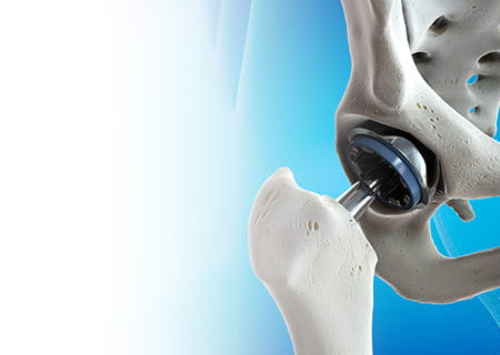 Orthopedic illustration of hip replacement