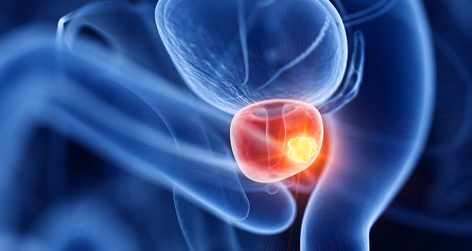 Illustration of prostate cancer