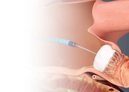 Illustration of the Watchman Device Implant