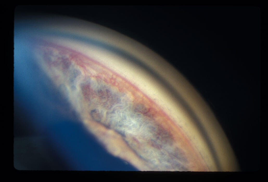 corneal transplantation expanded to include older donors