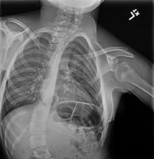 X-ray of Paige's spine before surgery