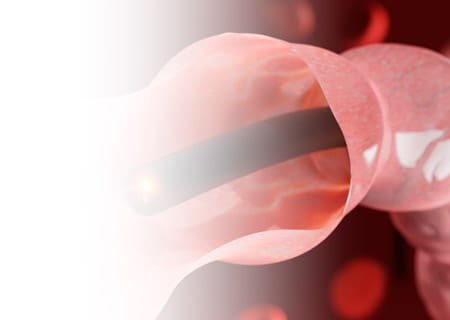A cutaway illustration of endoscope inside colon with polyp