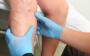 Varicose and Spider Veins: What's the Difference – and What To Do