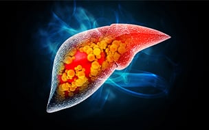 New Developments in Treating Fatty Liver Disease