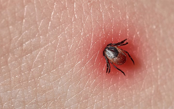 Close-up of a tick biting into skin, causing an enflamed reaction