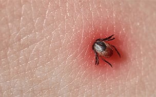 Alpha-Gal Syndrome: The Meat Allergy Caused by a Tick Bite
