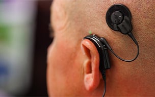 Next-Generation Cochlear Implants Protect Natural Hearing