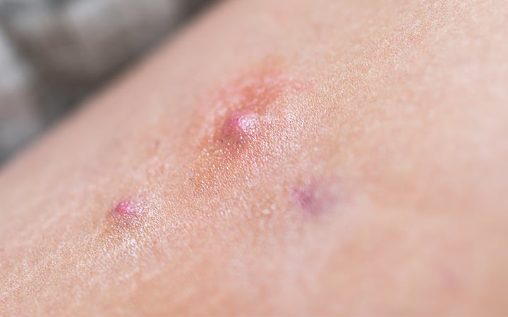 A closeup of a red swollen boil on the leg skin of a woman, showing a medical condition called hidradenitis suppurativa