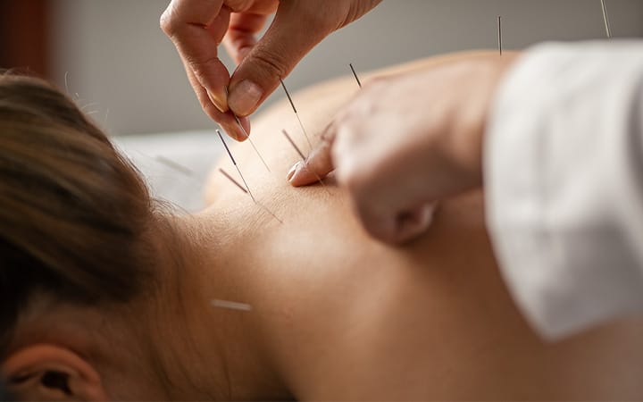 A young woman getting an acupuncture treatment on her back