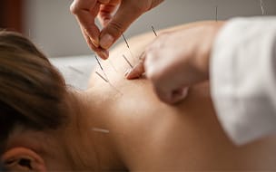5 Acupuncture Myths Debunked