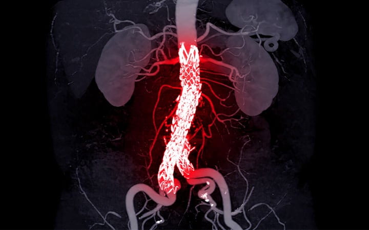 Illustration of a whole aorta with an Abdominal aorta stent graft 