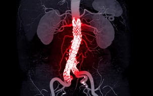 Can You Live With an Aortic Aneurysm?