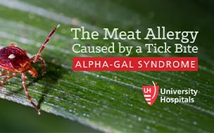 The Meat Allergy Caused by a Tick Bite: Alpha-Gal Syndrome