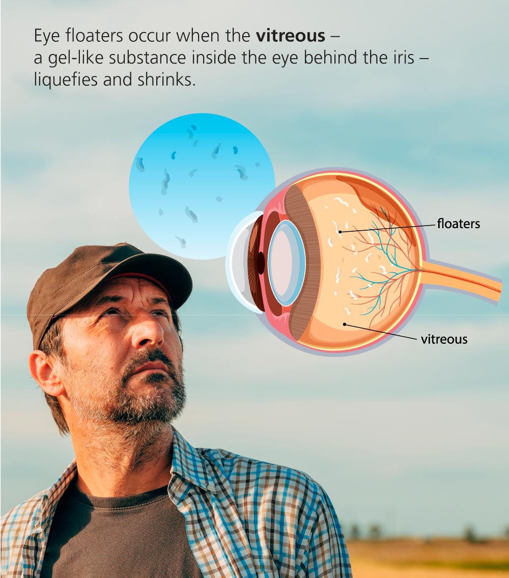 Infographic: What Do Eye Floaters in Your Vision Mean?