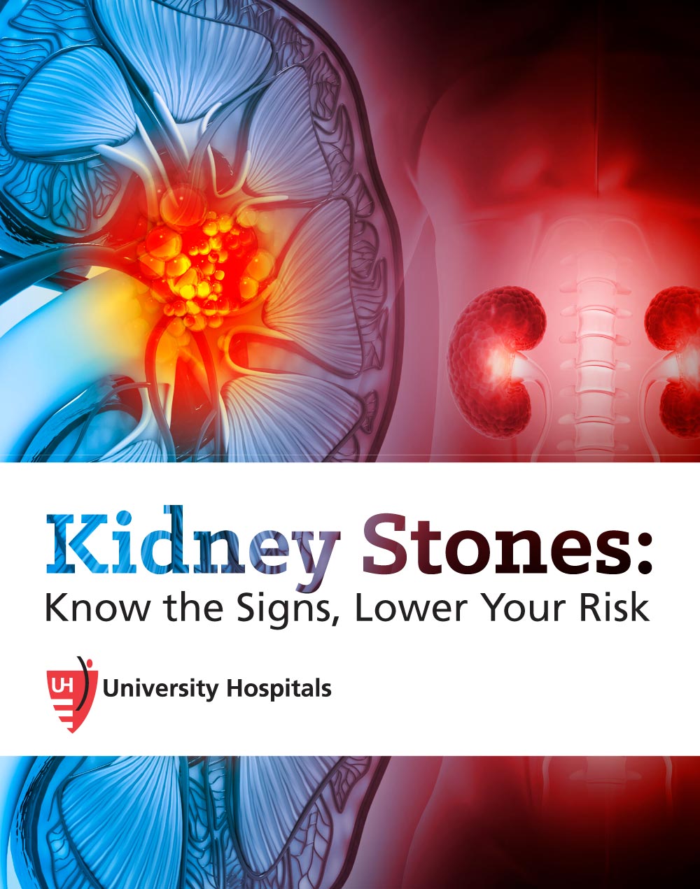 Kidney Stones: Know the Signs, Lower Your Risk
