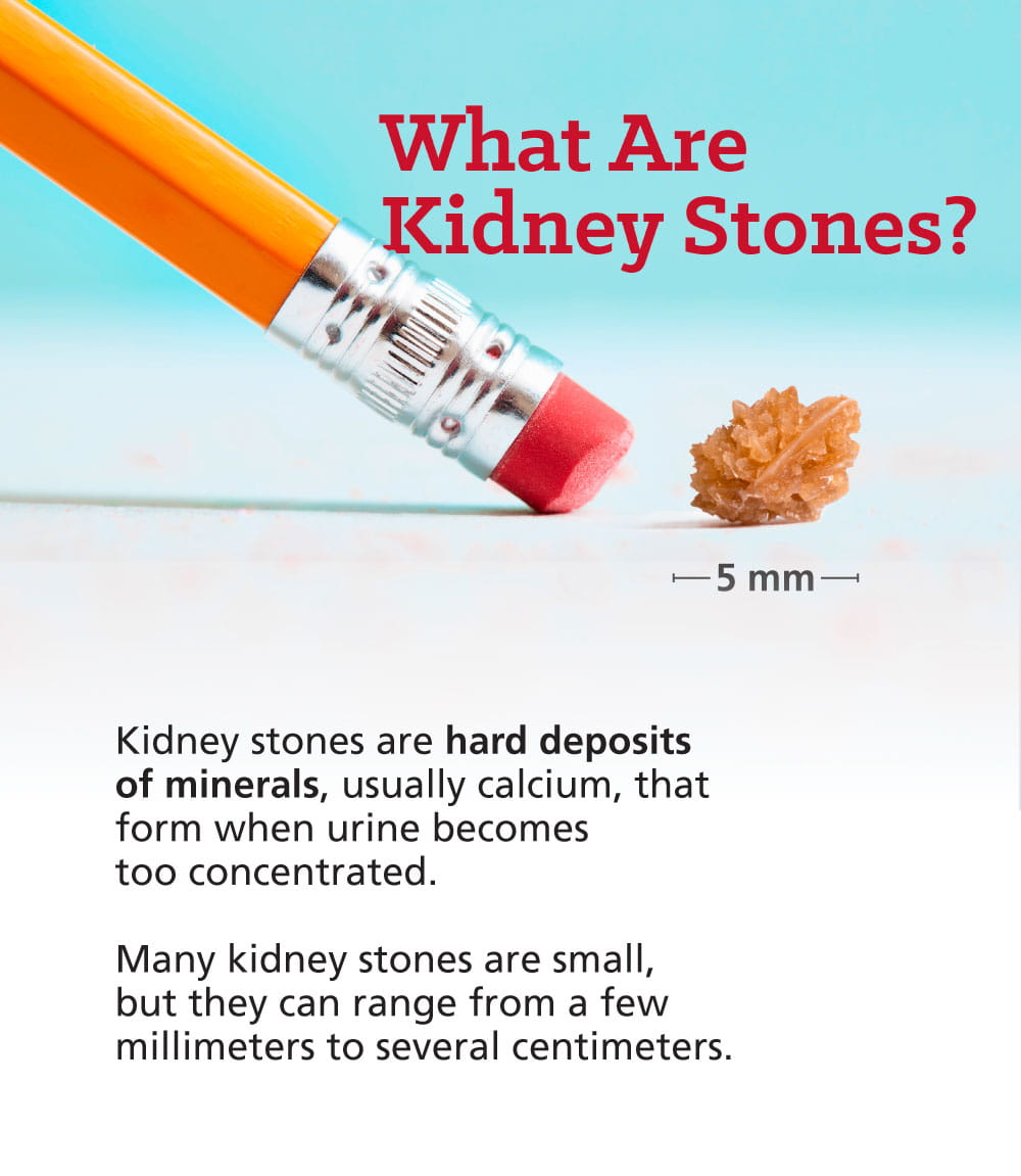 Kidney Stones: Know the Signs, Lower Your Risk