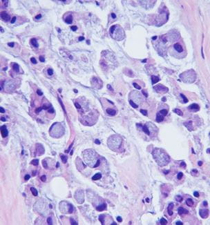 Colon Cancer Rings Signet Ring Colon Cancer | University Hospitals