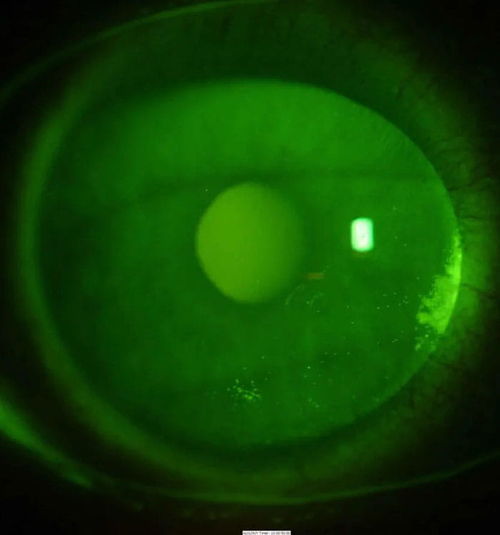Up close image of cornea scan in green color.