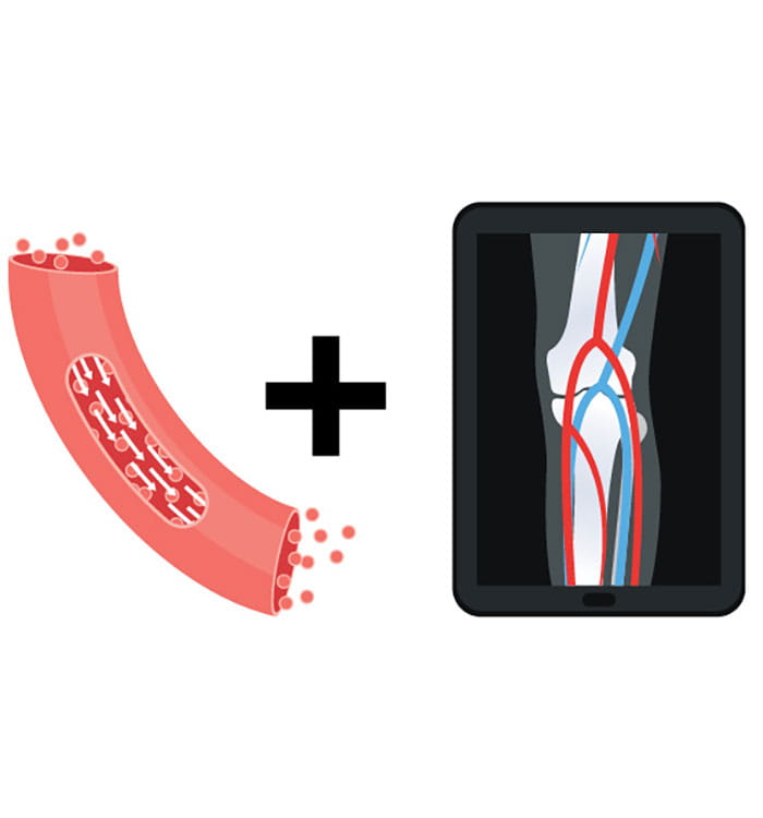 Illustration of vascular vessel and bone scan depicting collaboration between Cardiovascular and Orthopaedics.