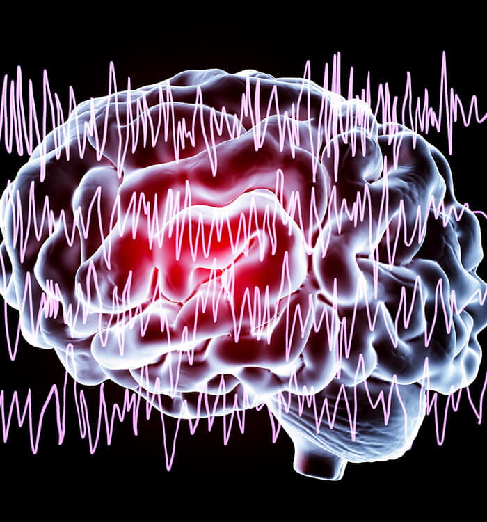 Epilepsy illustration