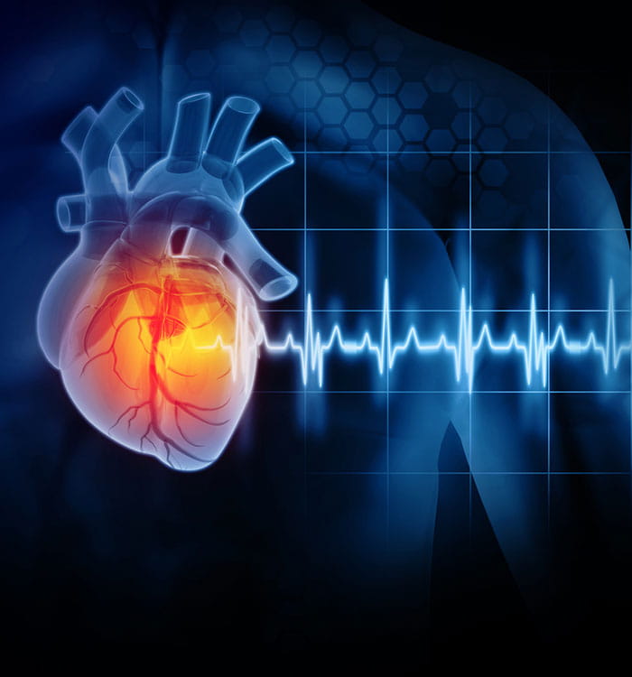 3D Illustration depicting heart attack and heart rhythm.
