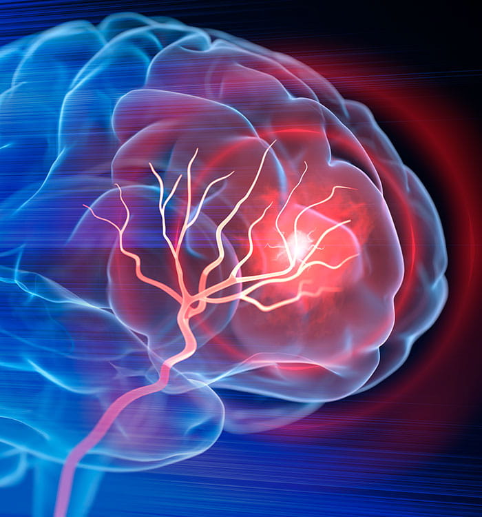 Illustration of brain activity depicting stroke blockages.