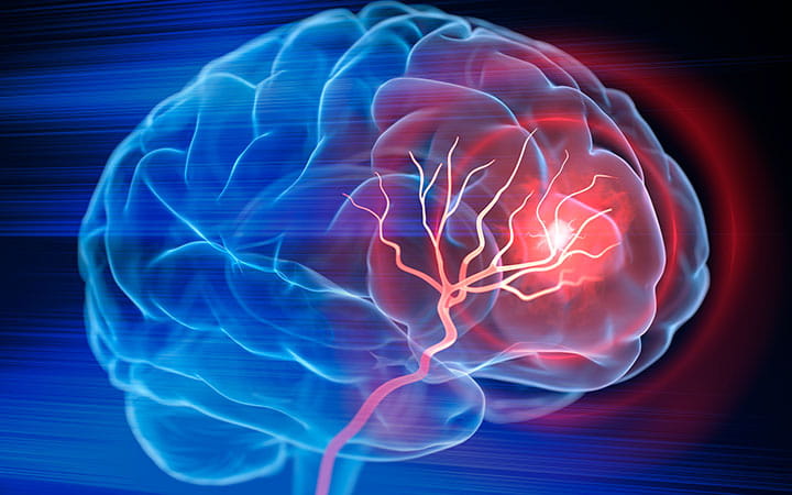 Illustration of brain activity depicting stroke blockages.