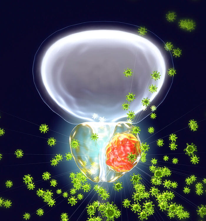 Getty image of prostate cancer concept