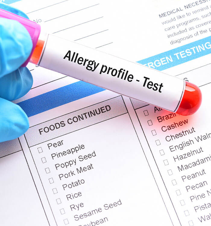 Lab vile with Allergy profile test label.