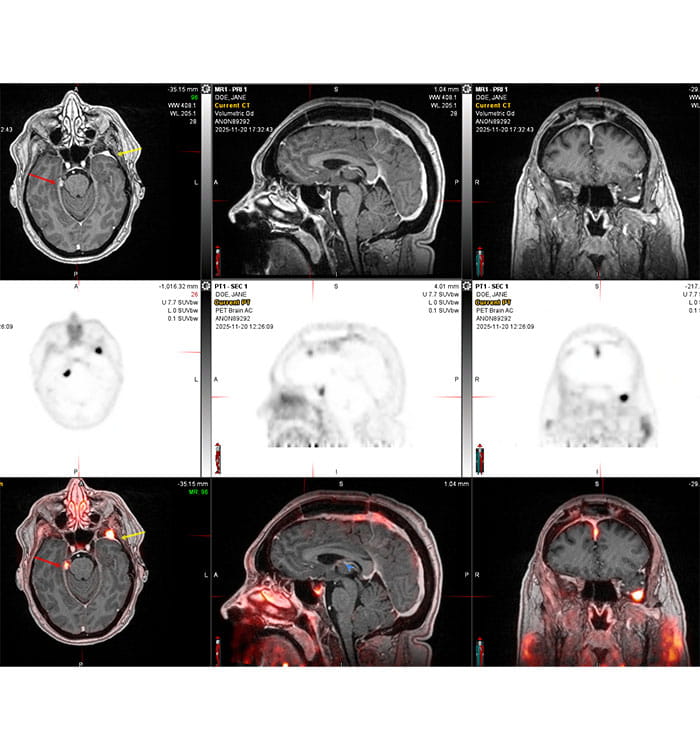 Comparison of MRI (top) and DOTATATE PET (bottom) scans.