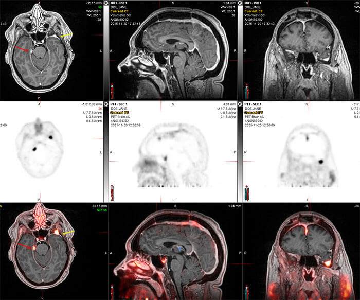 Neuro meningiomas scan comparison of MRI top and DOTATATE PET bottom.