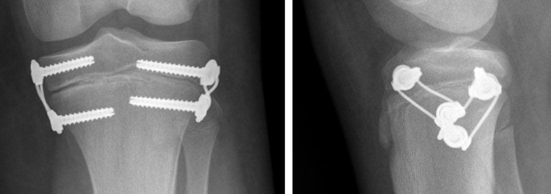 Scan of 9 year old girl presented with symptomatic external tibial torsion in combination with other deformities and was treated with rotational guided growth as a portion of her care. The implants are oblique to the growth plate on the lateral view.