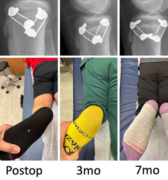 Radiographs in patient show how angle between the implants converge as the child grows. The corresponding clinical photos for each xray show how the angle between the thigh and the foot gradually improves with this process, with the position nearly normal at 10 months after surgery.