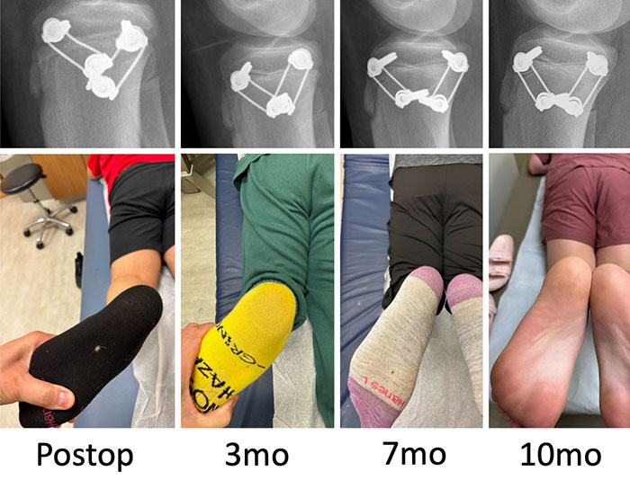 In the same patient, these radiographs show how angle between the implants converge as the child grows. The corresponding clinical photos for each xray show how the angle between the thigh and the foot gradually improves with this process, with the position nearly normal at 10 months after surgery.