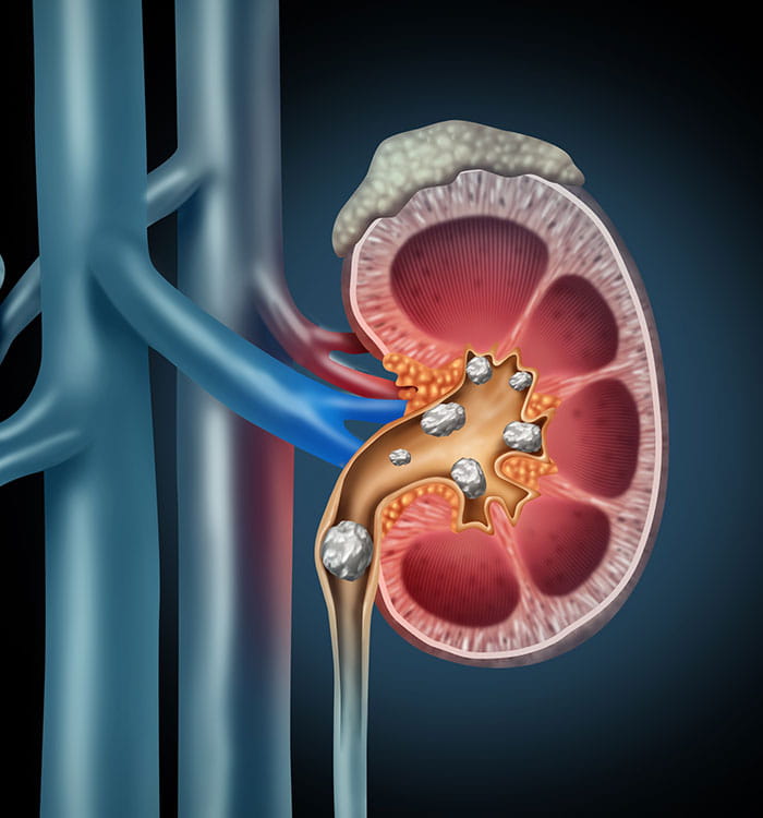 Illustration of kidney showing condition of existing stones.