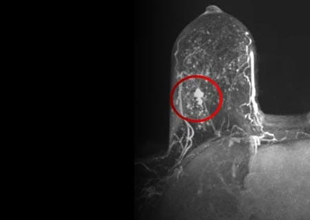 Breast MRI