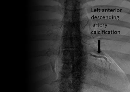 New Imaging Techniques to Identify Coronary Disease