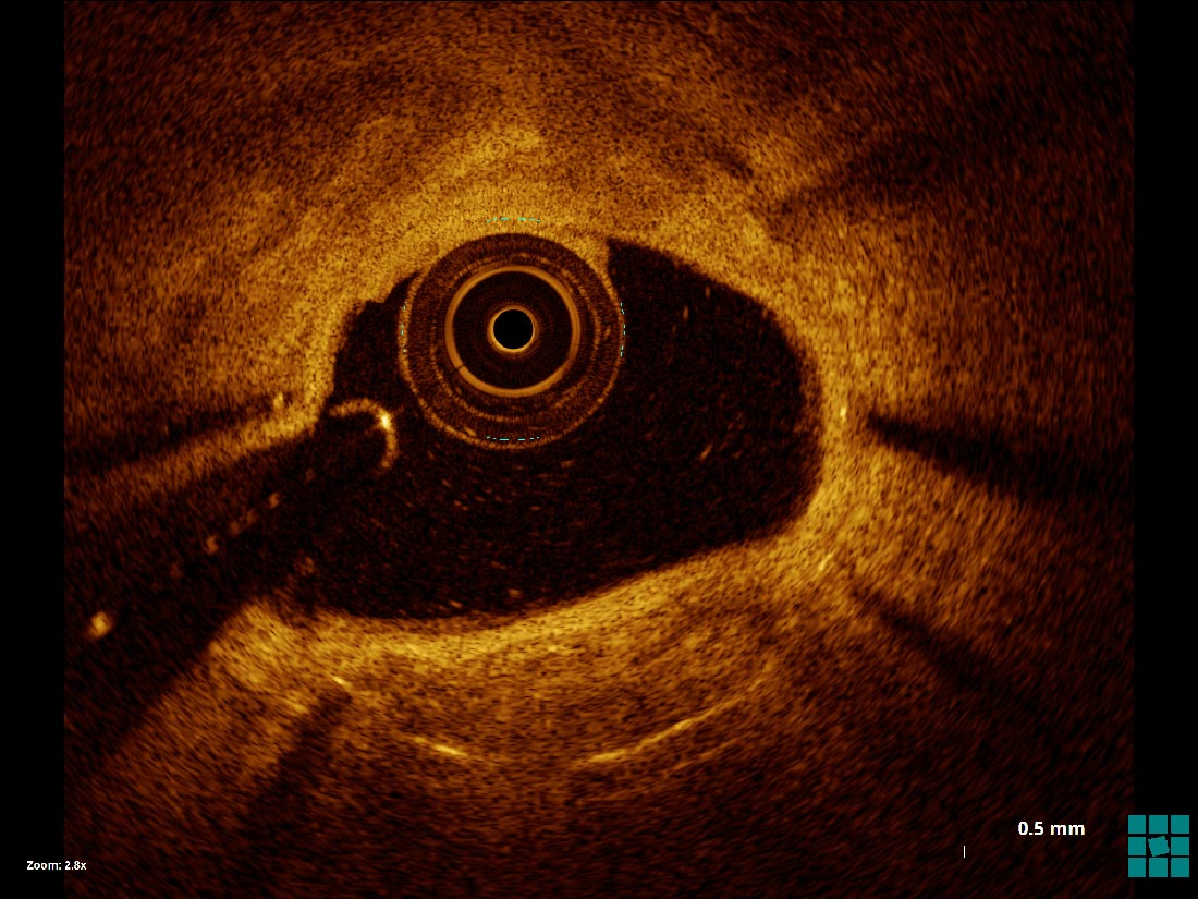 neo calcification seen on OCT