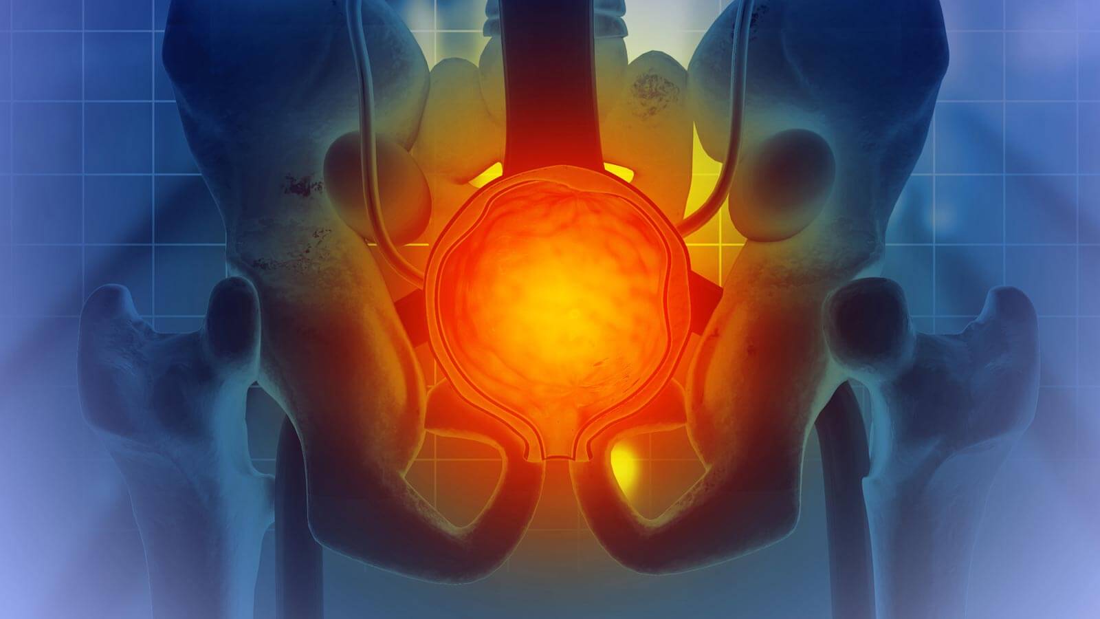 benign prostatic hyperplasia illustration