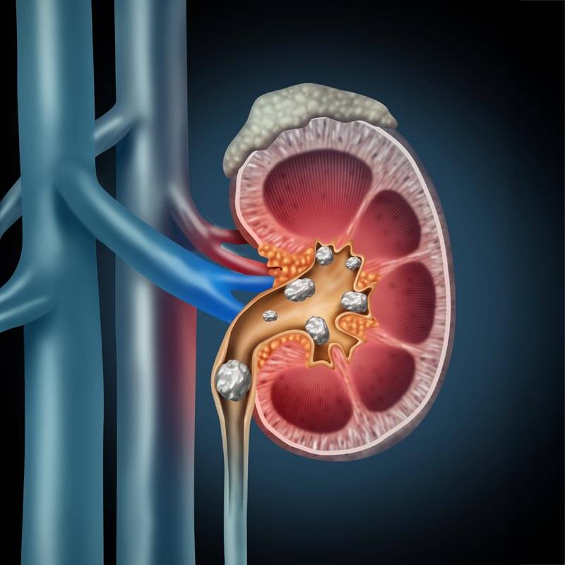 illustration of a kidney with stones