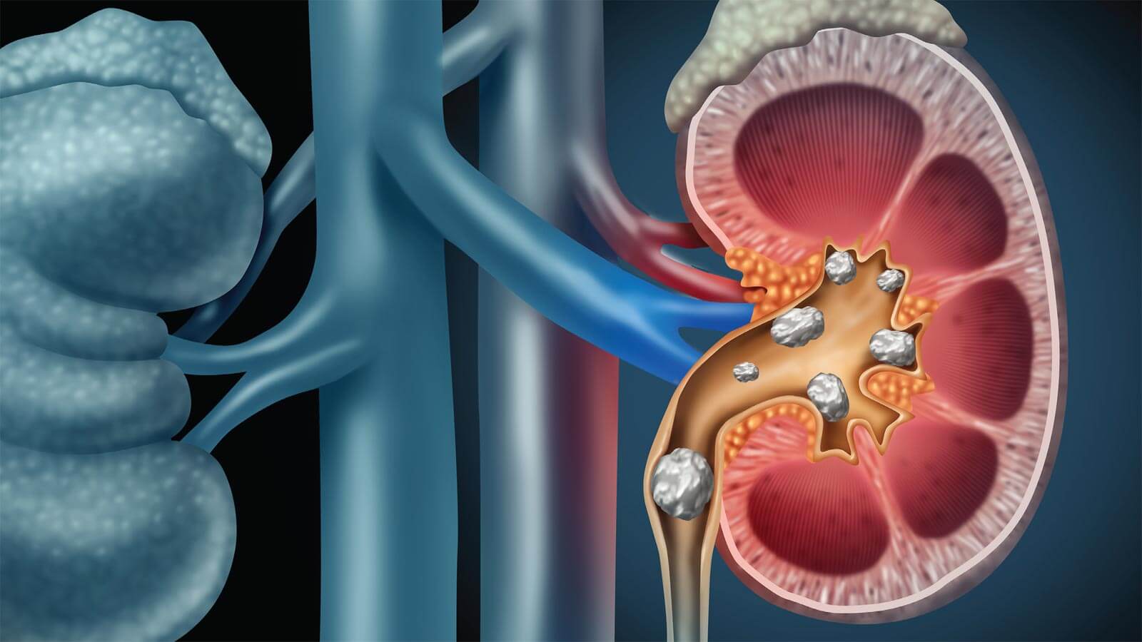illustration of a kidney with stones