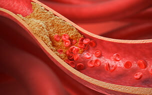 3D illustration of thickened arteries and veins with red blood cells demonstrating high blood cholesterol