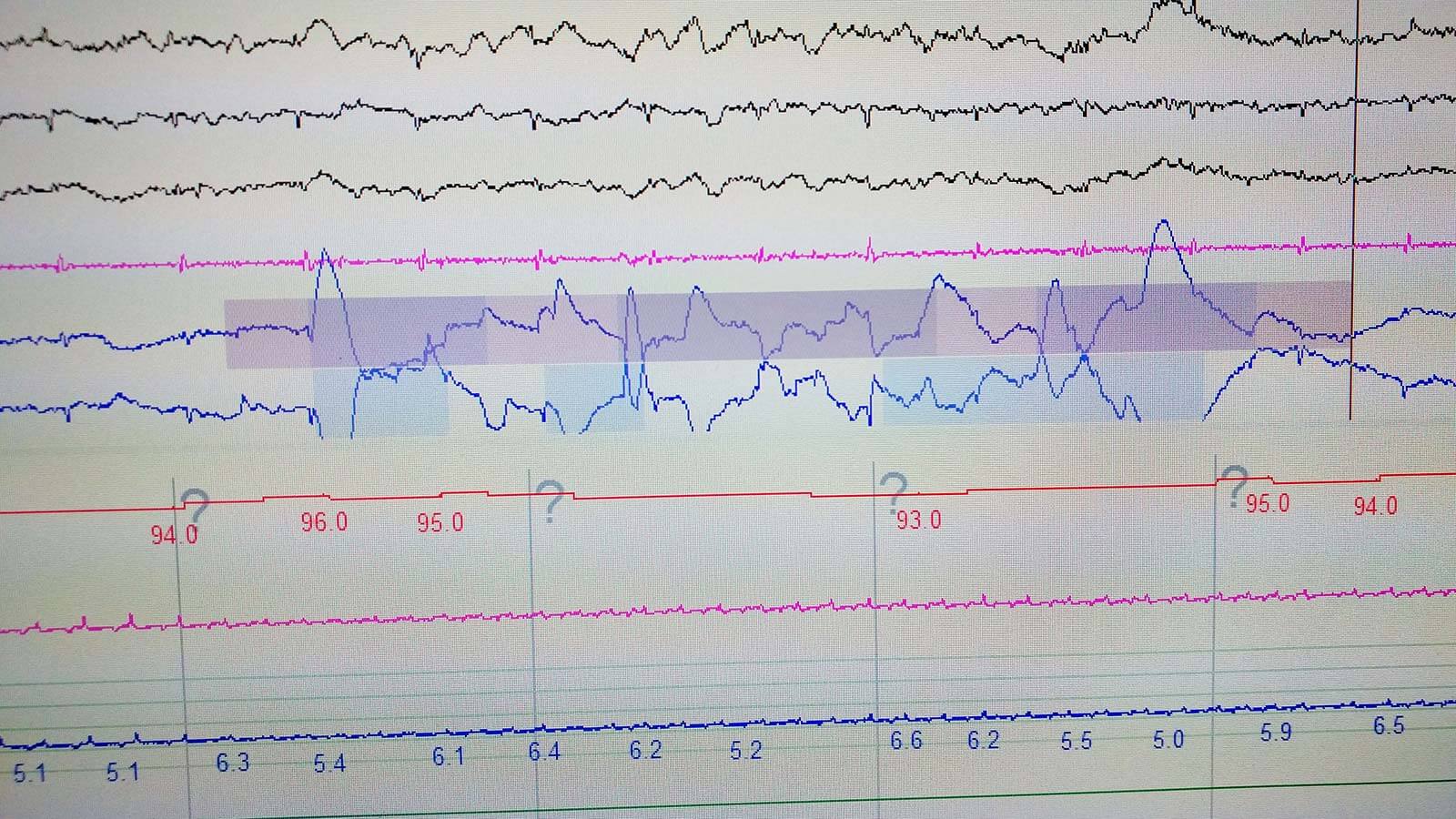 Close-Up Of Polysomnography Graph