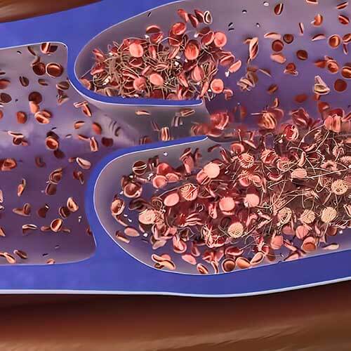 Hemophilia - Coagulation and how blood clots