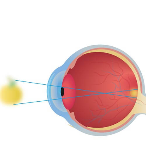 eye with Amblyopia