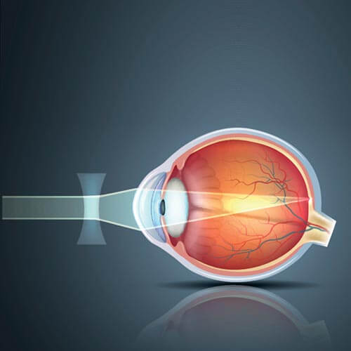 myopia diagram
