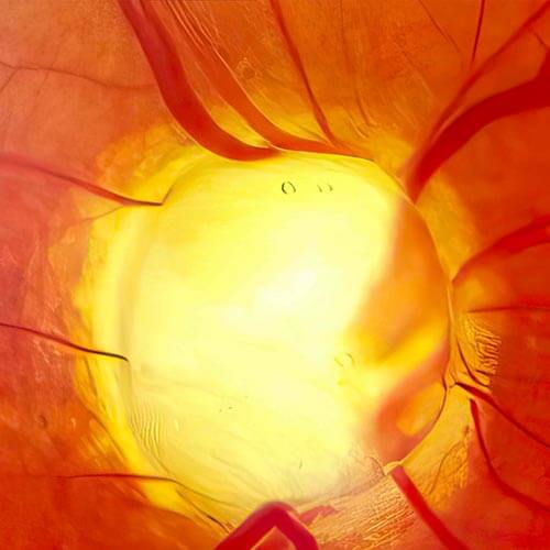 optic nerve in advanced glaucoma