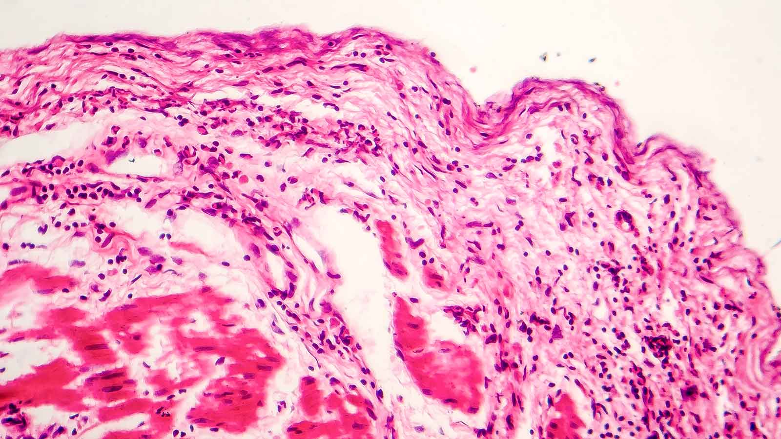 Signet Ring Cell Carcinoma